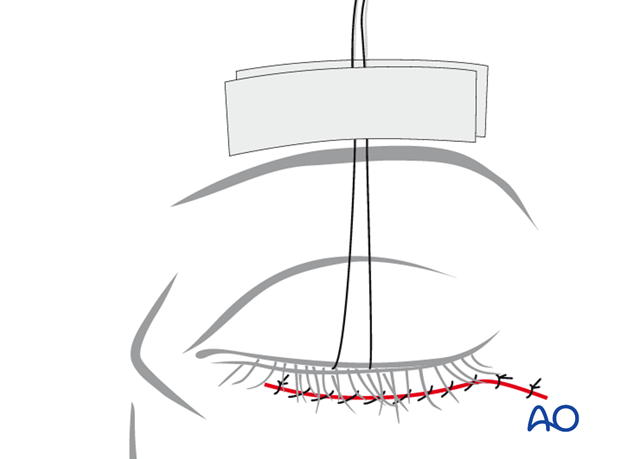 subciliary approach