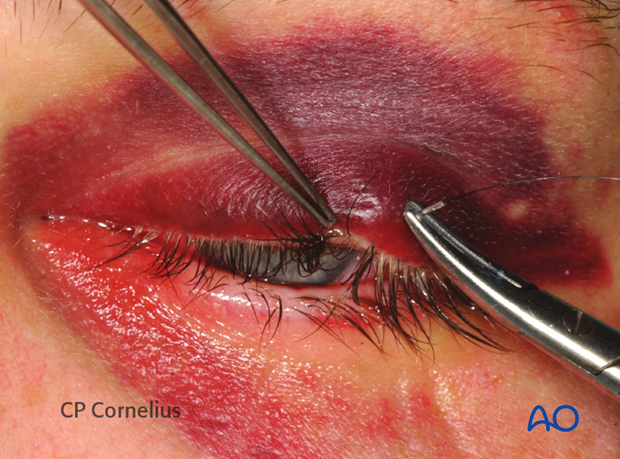 Transcutaneous lower-eyelid approach