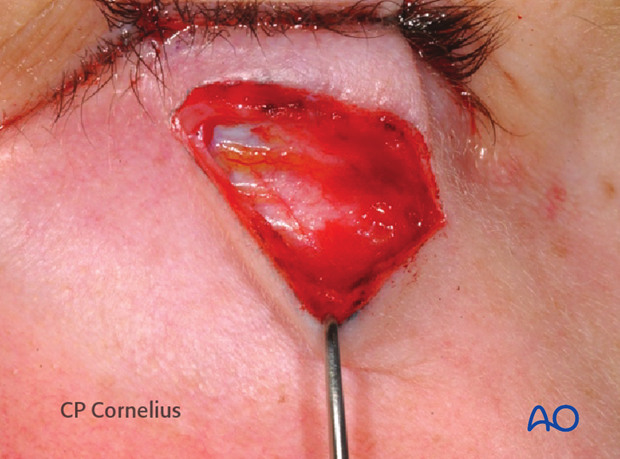 Subtarsal approach