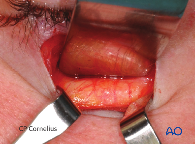 Subtarsal approach