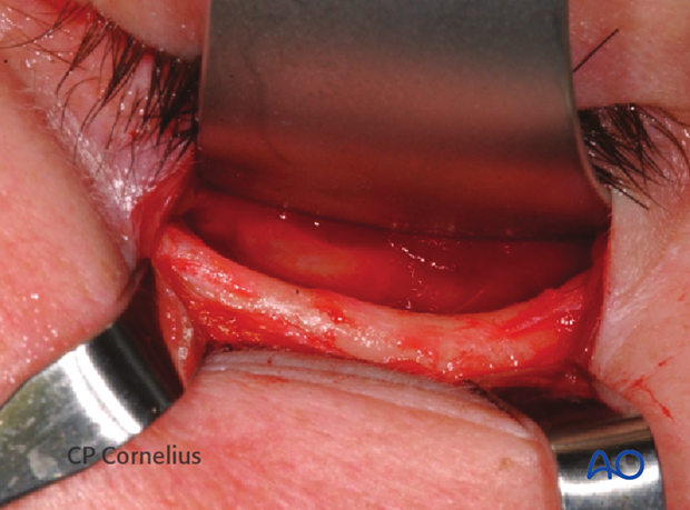 Subtarsal approach