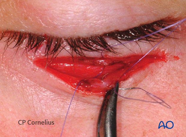 Subtarsal approach