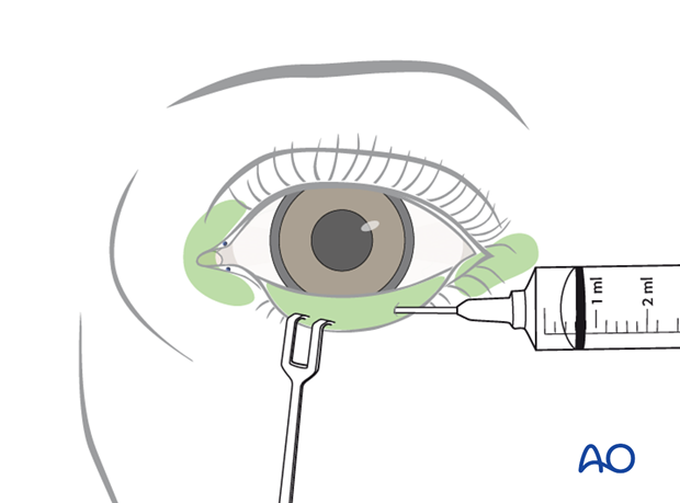 Transconjunctival lower-eyelid approaches