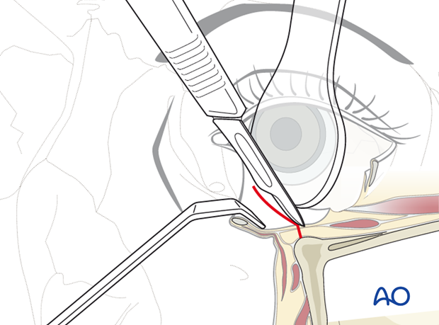 Inferior fornix transconjunctival 