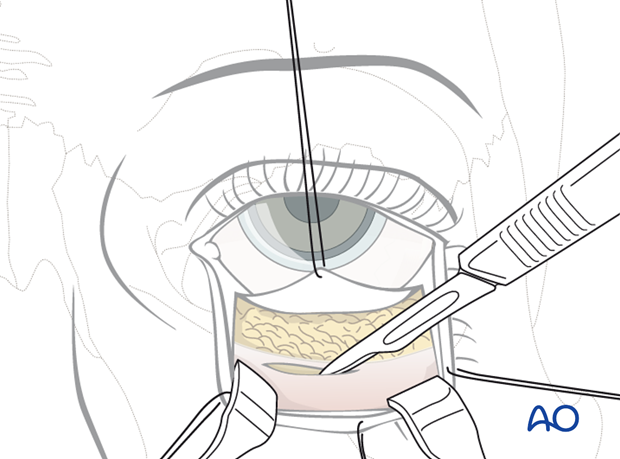 Inferior fornix transconjunctival 