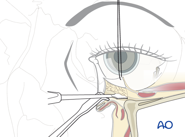 Inferior fornix transconjunctival 