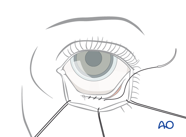 Inferior fornix transconjunctival 