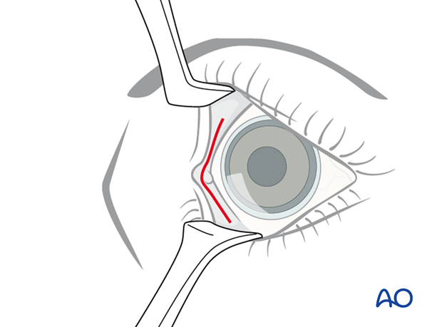 Pre-/Transcaruncular approach