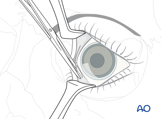 Pre-/Transcaruncular approach