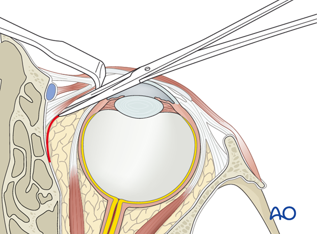 Pre-/Transcaruncular approach