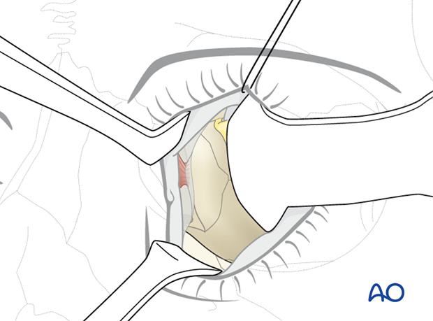 Pre-/Transcaruncular approach