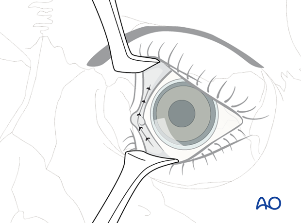 Pre-/Transcaruncular approach