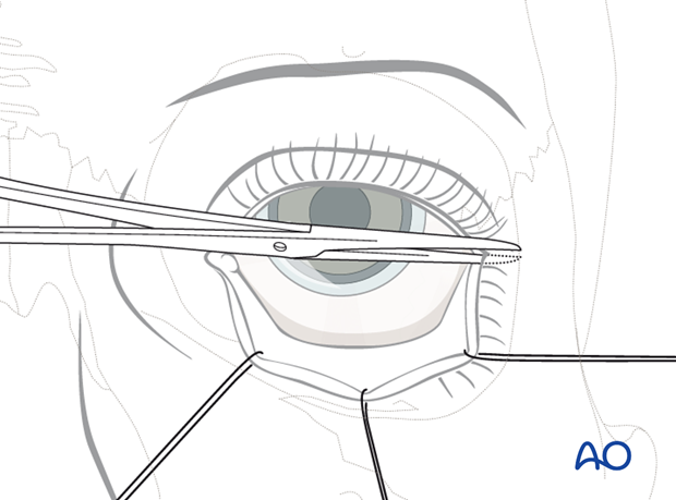 Transconjunctival approach with lateral skin extension