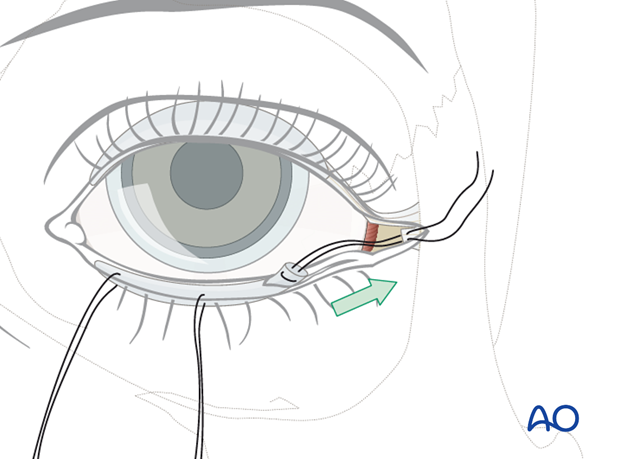 Transconjunctival approach with lateral skin extension