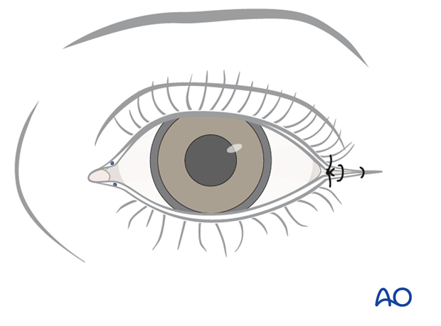 Transconjunctival approach with lateral skin extension