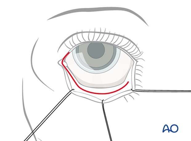 Combination of inferior and medial transconjunctival