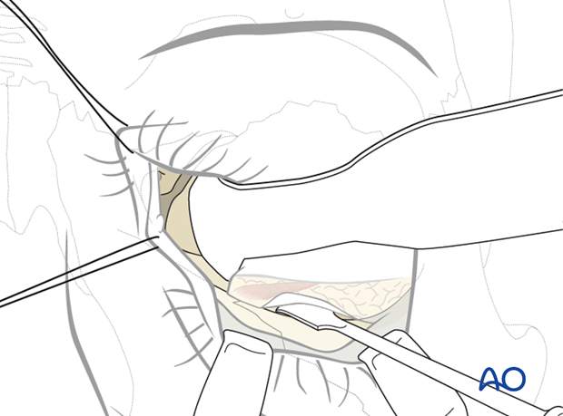 Combination of inferior and medial transconjunctival