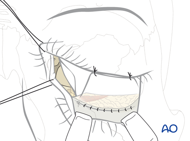 Combination of inferior and medial transconjunctival