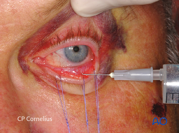 Transconjunctival lower-eyelid approaches