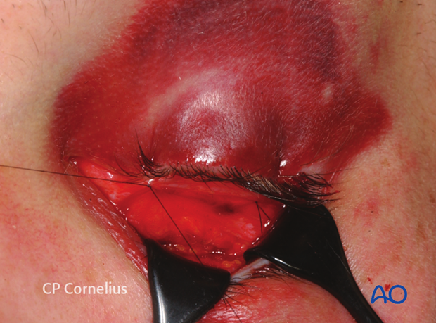 Transconjunctival lower-eyelid approaches