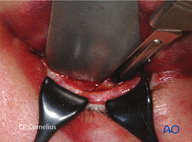 Inferior fornix transconjunctival 