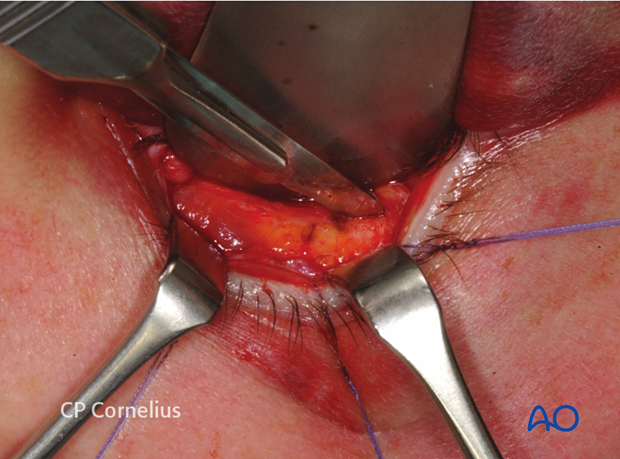 Inferior fornix transconjunctival 