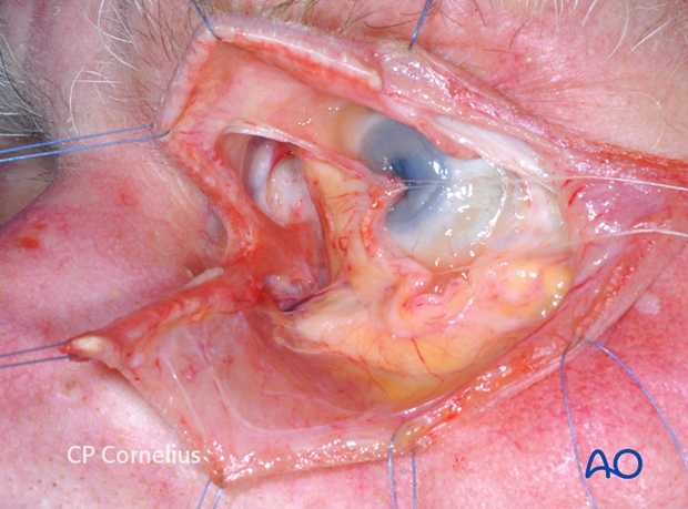 Pre-/Transcaruncular approach