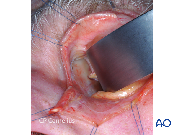 Pre-/Transcaruncular approach