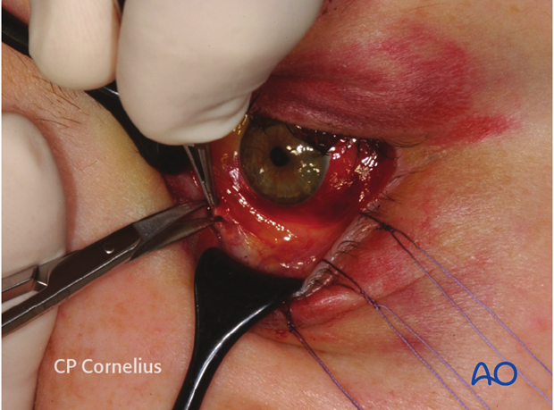 Pre-/Transcaruncular approach