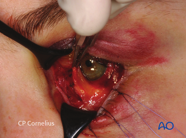 Pre-/Transcaruncular approach