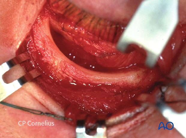 Transconjunctival approach with lateral skin extension