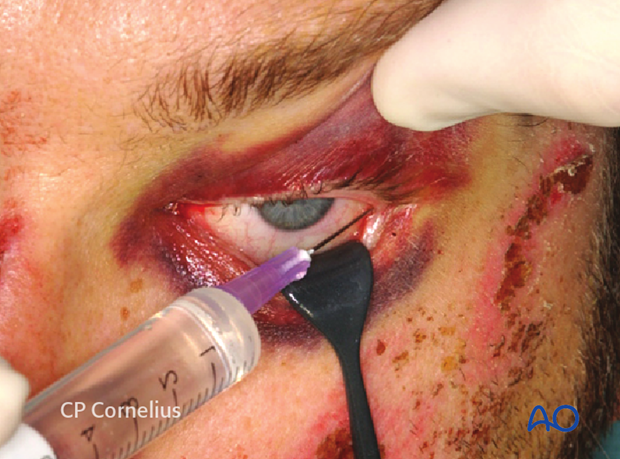 Transconjunctival approach with lateral skin extension