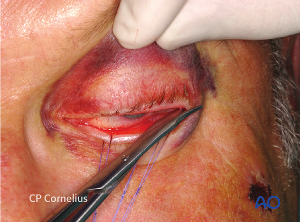 Transconjunctival approach with lateral skin extension