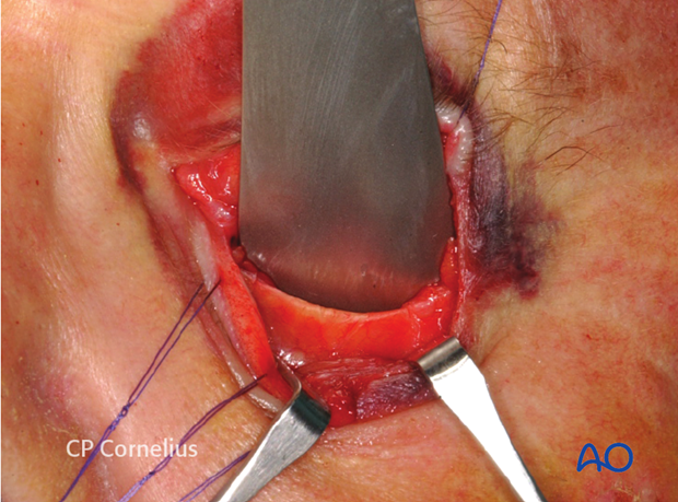 Transconjunctival approach with lateral skin extension