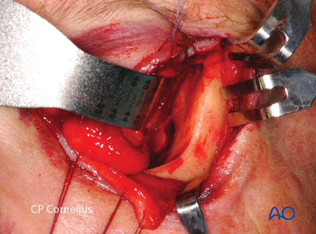 Transconjunctival approach with lateral skin extension