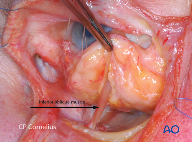 Combination of inferior and medial transconjunctival