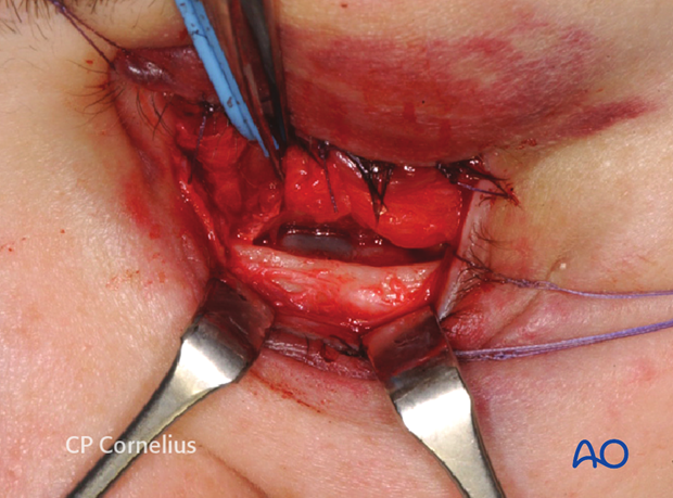 Combination of inferior and medial transconjunctival