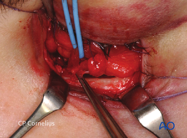 Combination of inferior and medial transconjunctival