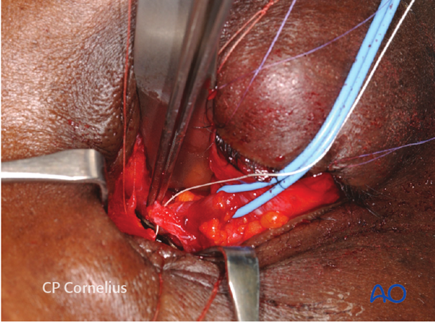 Combination of inferior and medial transconjunctival