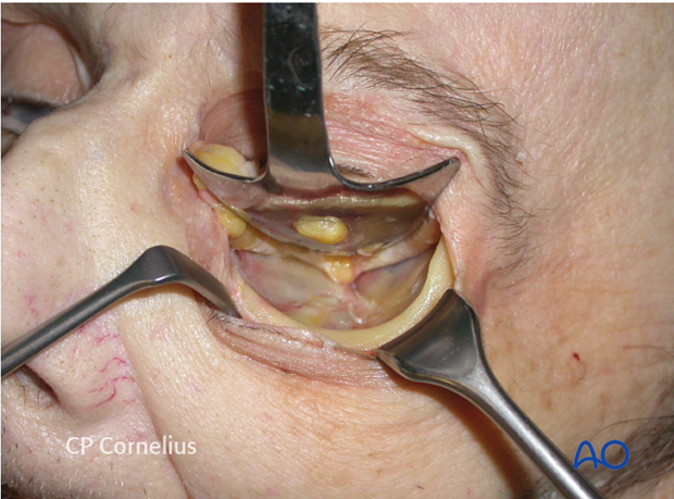 C-shaped incision