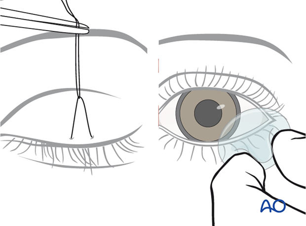 Extended glabellar approach