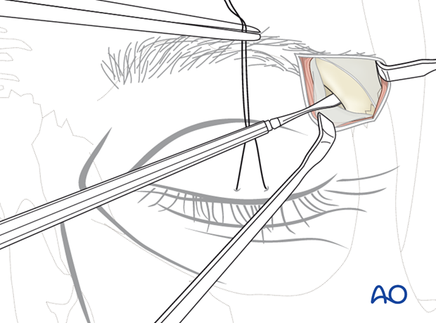 Lateral eyebrow approach