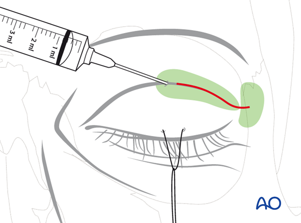 Extended glabellar approach