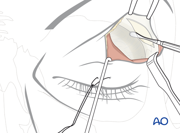 Upper-eyelid approach