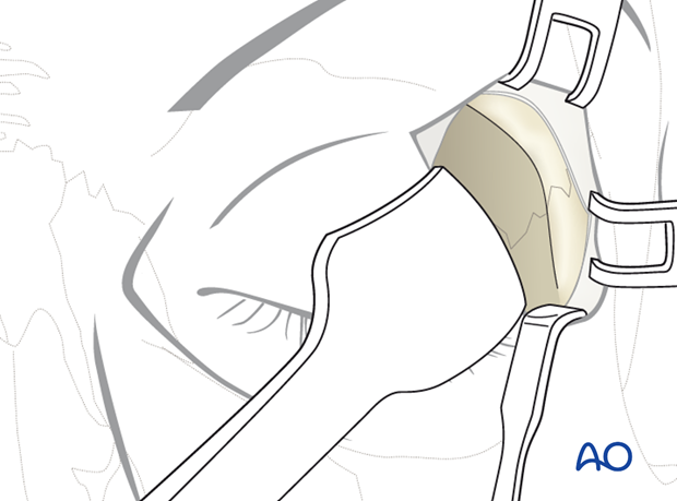 Upper-eyelid approach