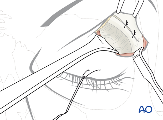 Upper-eyelid approach