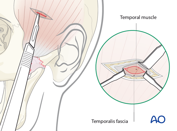 Indirect approaches to the zygomatic arch