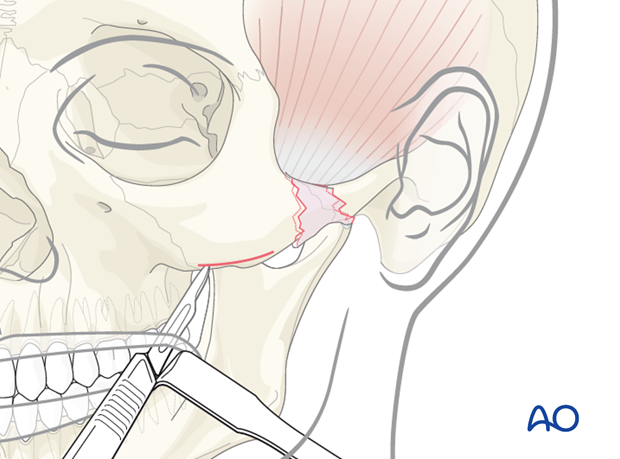 indirect approaches to the zygomatic arch temporal and transoral approaches