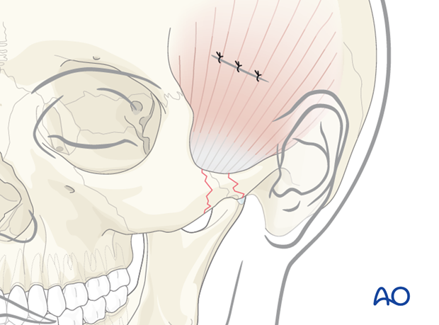 Indirect approaches to the zygomatic arch