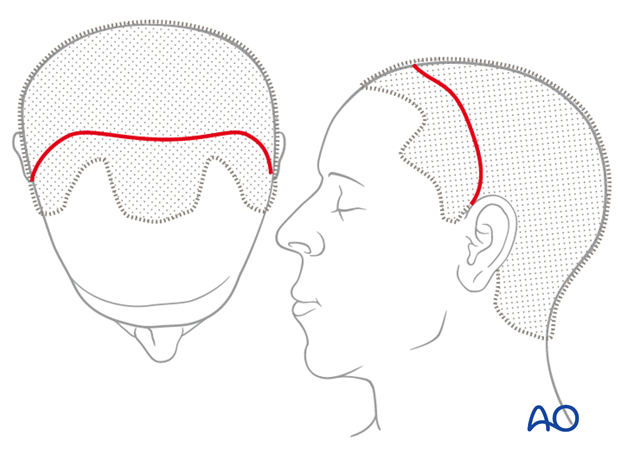 Location of scalp incision line